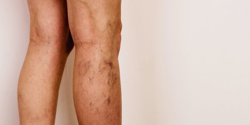 Does Ayurvedic Treatment Work for Varicose Veins: An Understanding
